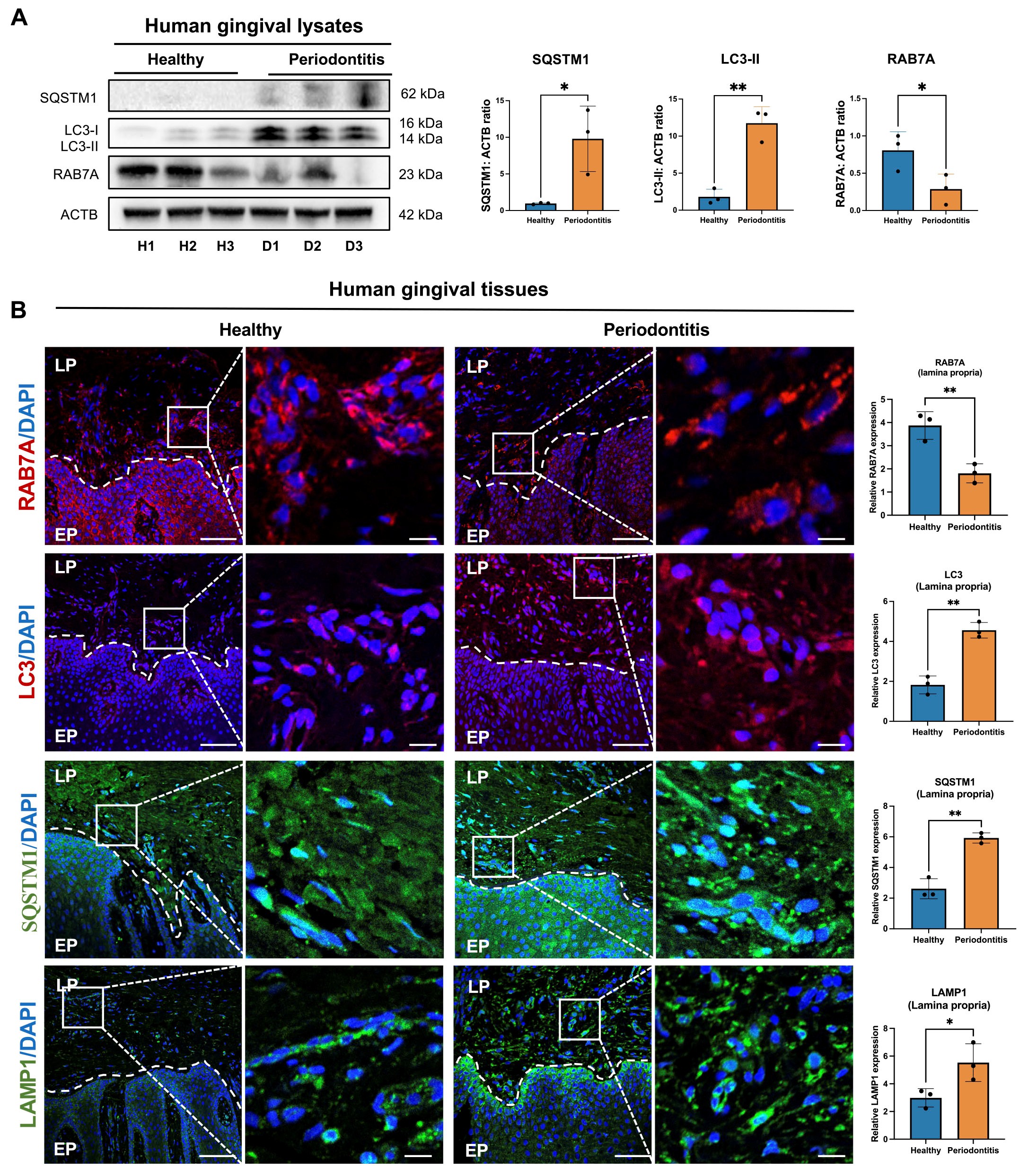 牙周炎患者牙龈中RAB7A表达降低，自噬水平受损