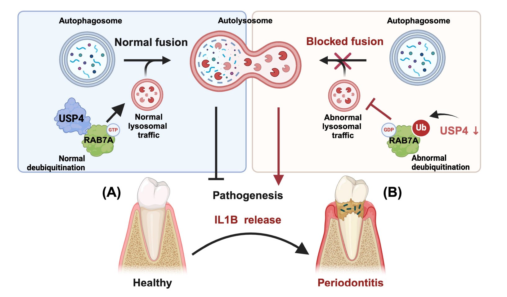 牙周病发病机制中RAB7A泛素化阻断自噬体-溶酶体融合的模型机理图