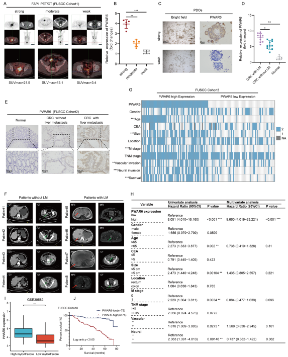 exo-PWAR6在CRC患者中的表达及其临床意义