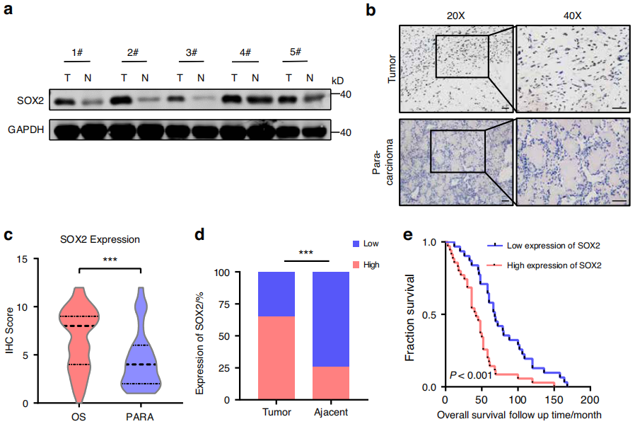 SOX2在OS组织中表达上调，且与不良预后相关