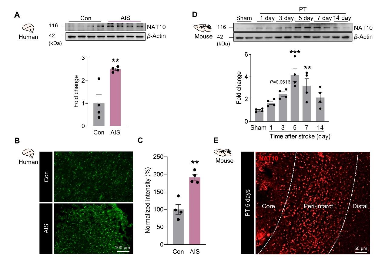 急性缺血性脑卒中患者和PT小鼠的NAT10上调